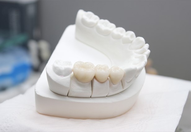 Dental Base Metal Alloy